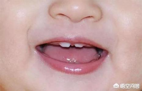 宝宝牙缝大是好事还是坏事为什么